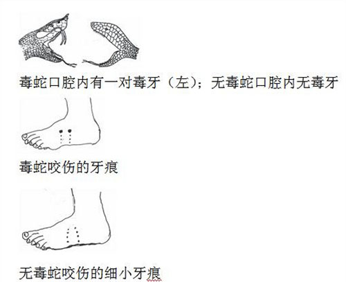 被蛇咬傷怎麼辦 被毒蛇咬了的急救方法及注意事項