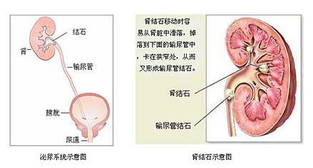 青年人容易成為結石的“最愛”