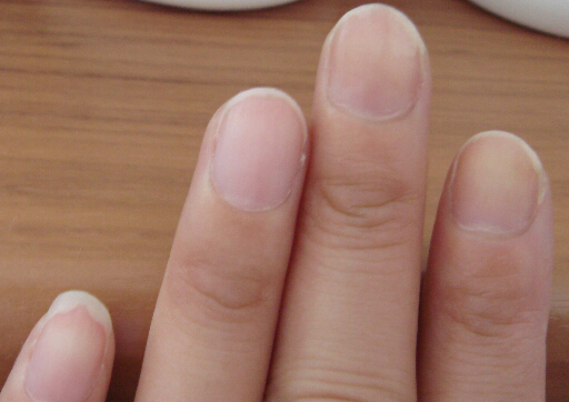 手指甲上有豎紋怎麼辦？指甲上有黑色豎紋是怎麼回事