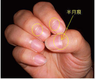 指甲上的半月痕你懂多少？指甲半月痕與健康吉凶