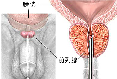 前列腺炎危