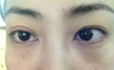 女人腎虛的症狀2：眼睑浮腫、黑眼圈加重、面色蒼白