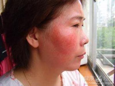 臉部皮膚過敏用可以用老皮匠草本抑菌乳膏