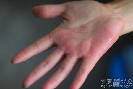 手掌心皮膚非常粗糙,是缺什麼元素嗎?