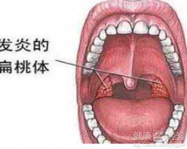 扁桃體經常腫大,該怎麼保養