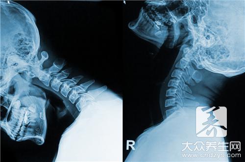 頸椎病不能吃什麼